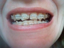 To insist my dentist to put my front teeth back as they were?