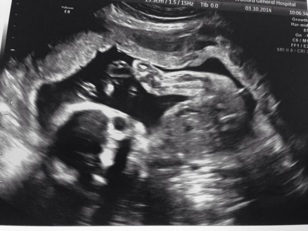 Boy or Girl?