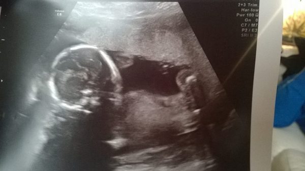 March Mummies 2015 - to second tri and beyond we go, bumps appearing and sickness (hopefully) disappearing