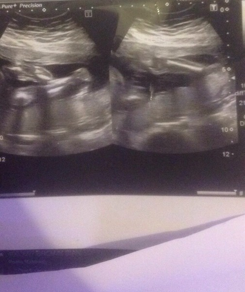 Would you trust this gender scan from student midwife?