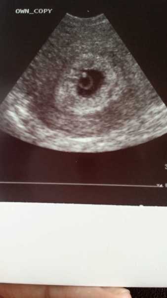 Can you see the heartbeat at 6 week scan?
