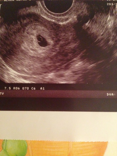 June 2015 - thread 2 -- morning sickness/sore boobs and early scans a plenty! [title edited by HQ]