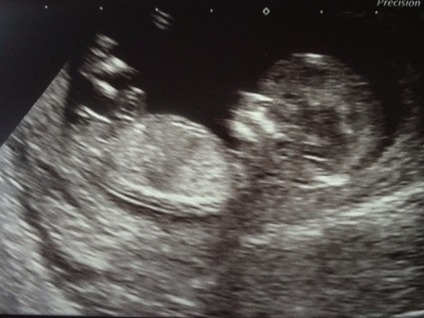 Praying history doesn't repeat itself (12 week scan)