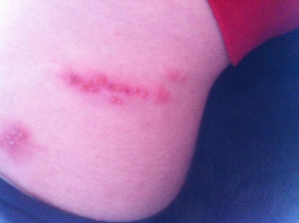 What the jeff is this?  Bites? Rash?