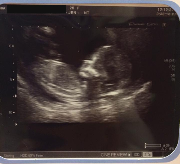 Tiptoeing into the Second Trimester... Due April 2015