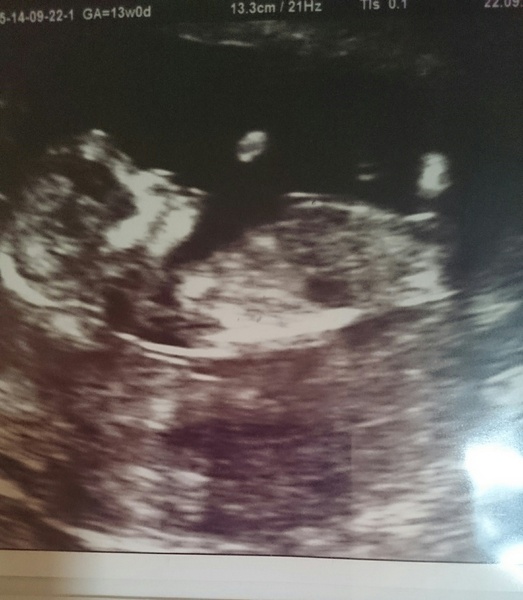 gender scan in the morning :)