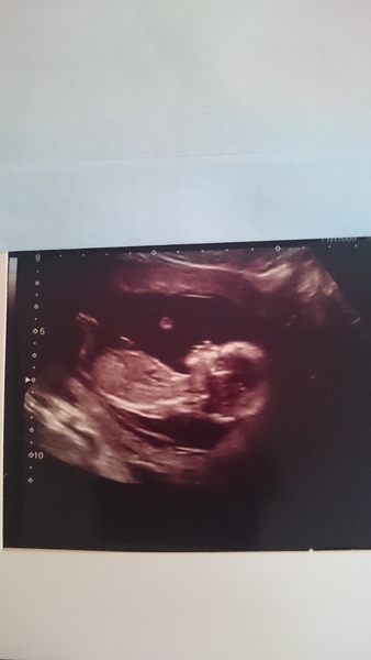 gender scan in the morning :)