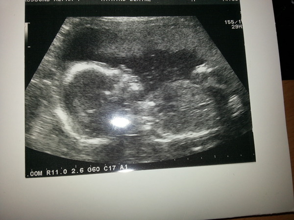 March Mummies 2015 - to second tri and beyond we go, bumps appearing and sickness (hopefully) disappearing