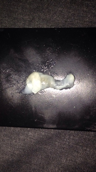 Mucas plug? Warning graphic pic