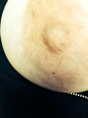 Scabby nipple with discharge