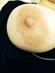 Scabby nipple with discharge