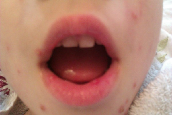 DD has chicken pox quite bad please please offer advice when pharmacists disagreed whst i should use!