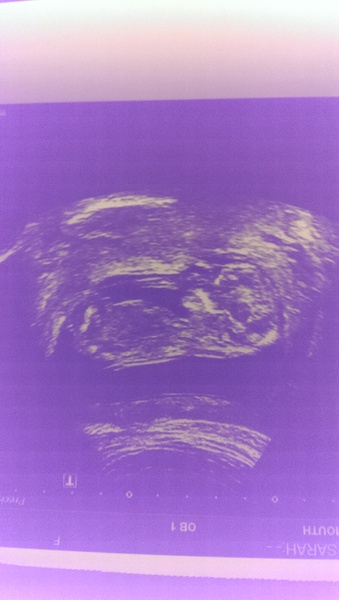 12 week scan!! Any guesses would love to know thoughts!