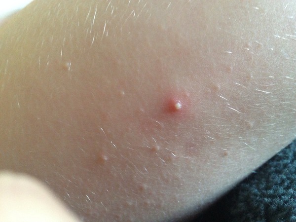 Three year old with spots