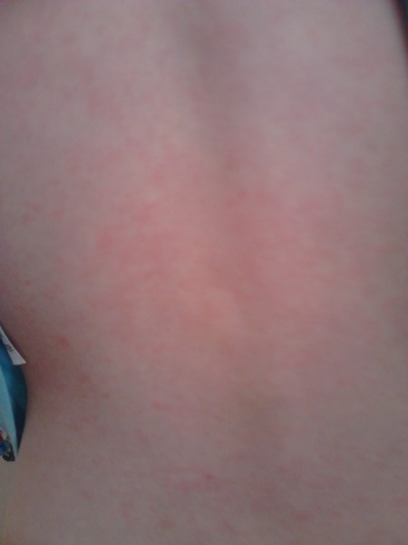 What is this rash?