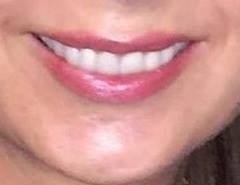 Anyone had their teeth improved? What did you get done? Were you pleased?