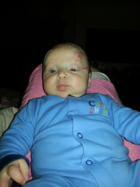 Strawberry Birthmark