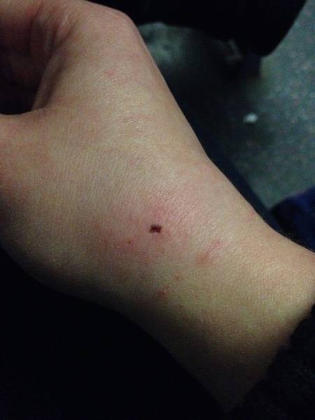 In agony with this cat bite :/