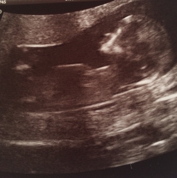 Just Shagging Grads 14: Join the viroids for scanxiety, Toni Braxtons, & a little less JSing than usual!