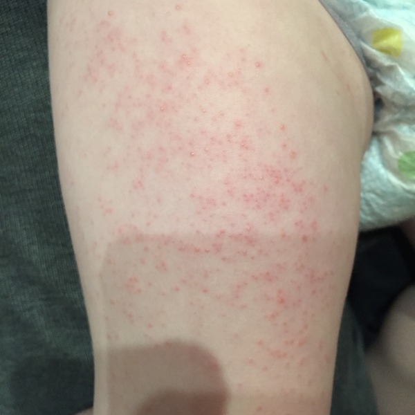 Unidentified rash - help please?