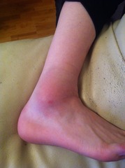 Ds fell yesterday and his ankle is still swollen today