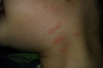 Centra ben allergic reaction or another phase in the "illness"