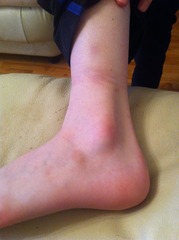 Ds fell yesterday and his ankle is still swollen today