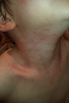 Centra ben allergic reaction or another phase in the "illness"