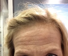 Had secret  botox this morning