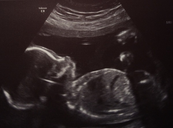 Taking the Plunge: Pregnancy thread