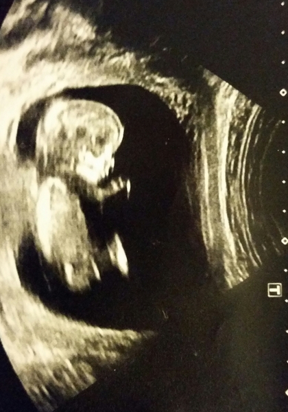 12w scan nub/skull theories