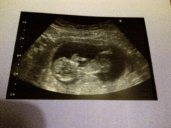 20 week scan tomorrow