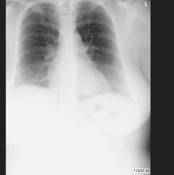 Little bit worried after Bronchitis - Sinus/Ear infection