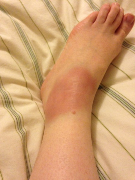 A few times a year my foot does this: