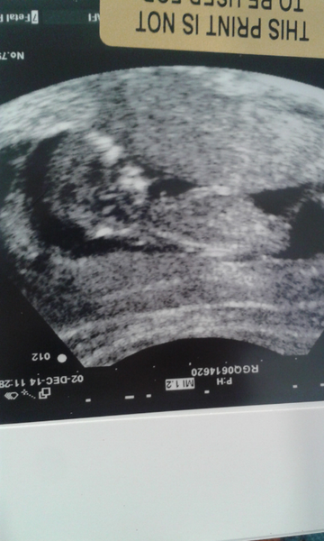 Hyperemesis Support