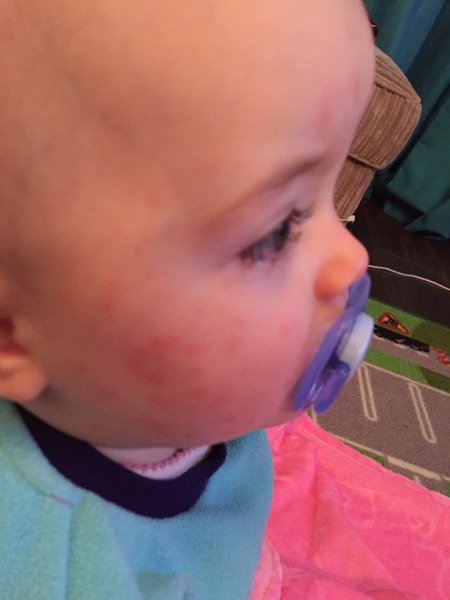 Posting for traffic, does this rash look like measles?
