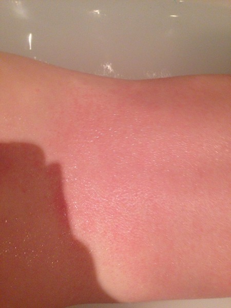 What is this rash?