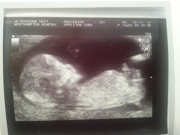 Next scan in two weeks boy or girl?