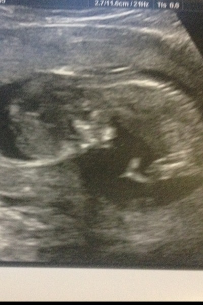 June 2015 - thread 6 - baby kicks and bumps appearing