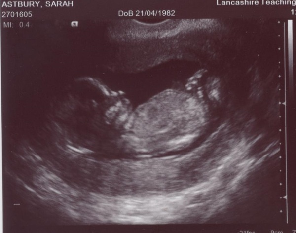 June 2015 - thread 6 - baby kicks and bumps appearing