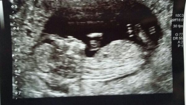 July 2015 - more and more beans are seen on scans