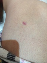 I've been bitten by my parents dog twice