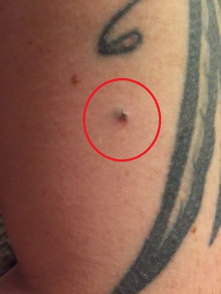 Is it stupid to go to the doctor about this mole