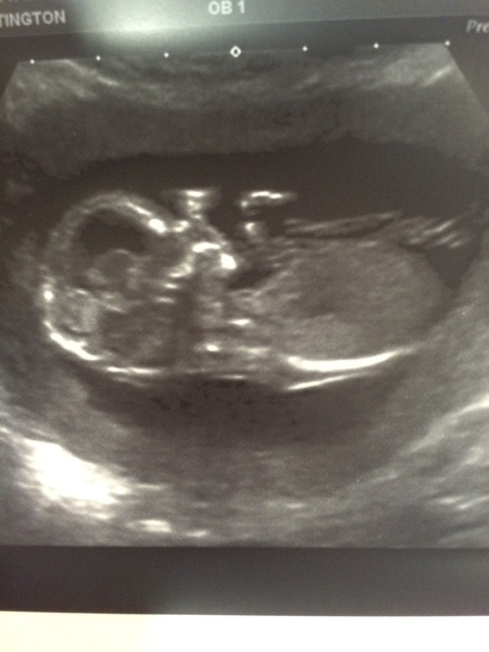 July 2015 - more and more beans are seen on scans