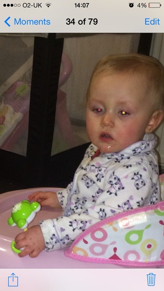 Should I worry retinoblastoma ?