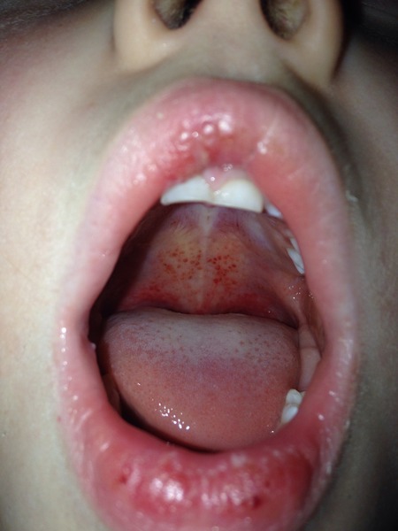 Glandular fever getting worse Dd 4yo