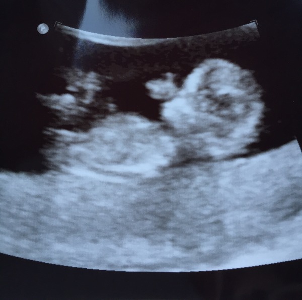 July 2015 - more and more beans are seen on scans