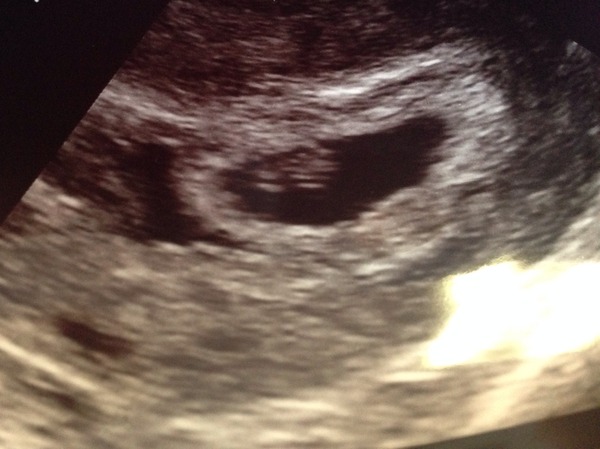 September 2015 Ante-Natal thread.