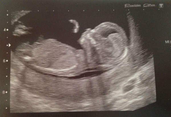 July 2015 - more and more beans are seen on scans