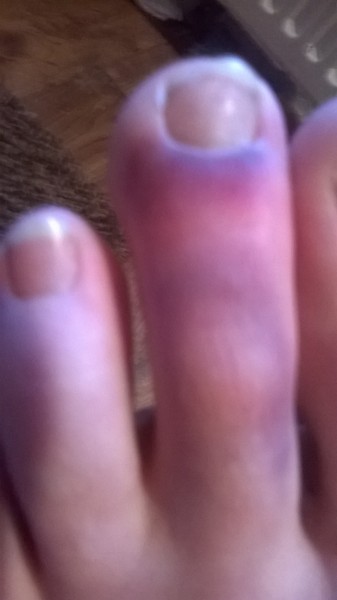to think that stubbing your toe is the most painful thing EVER?
